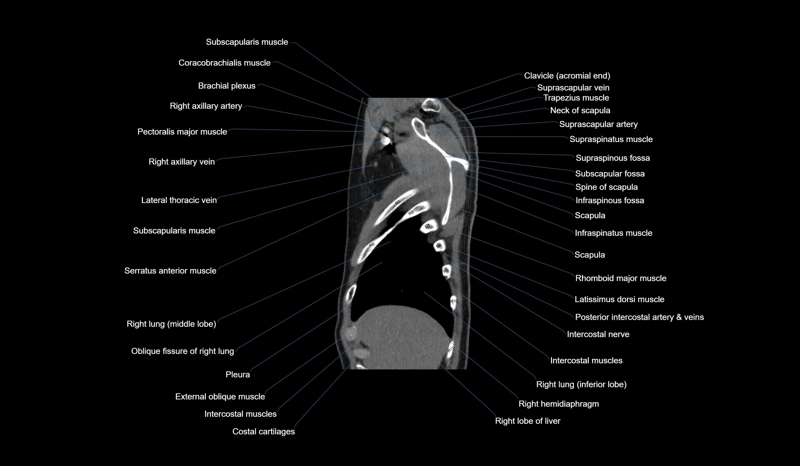 CT chest (thorax) labelled sagittal cross sectional anatomy radiology image-00021.webp